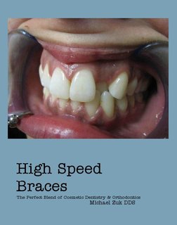 High Speed Braces